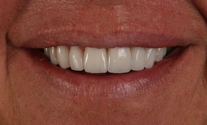 Veneers Case 3 - After