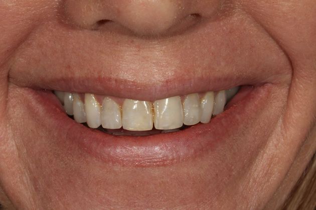 Veneers Case 3 - Before