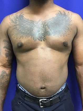 Male Breast / Gynecomastia: Case 6 (23223) - After