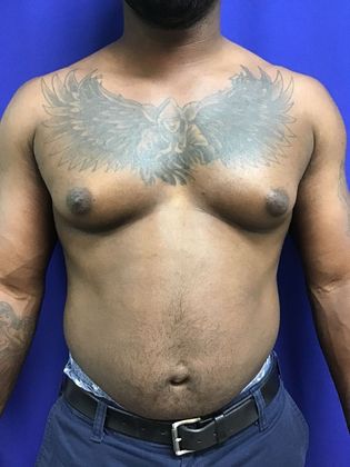 Male Breast / Gynecomastia: Case 6 (23223) - Before