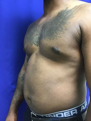 Male Breast / Gynecomastia: Case 6 (23223) - After