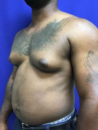 Male Breast / Gynecomastia: Case 6 (23223) - Before
