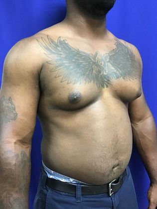 Male Breast / Gynecomastia: Case 6 (23223) - After