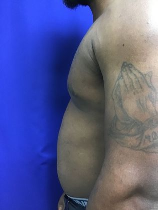 Male Breast / Gynecomastia Case 6 (23223) - After