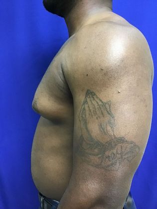 Male Breast / Gynecomastia Case 6 (23223) - Before