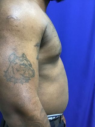 Male Breast / Gynecomastia: Case 6 (23223) - After