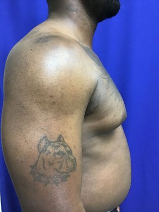 Male Breast / Gynecomastia: Case 6 (23223) - Before