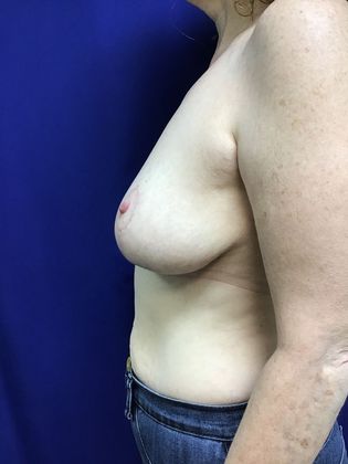 Breast Reduction: Case 28 (23323) - After