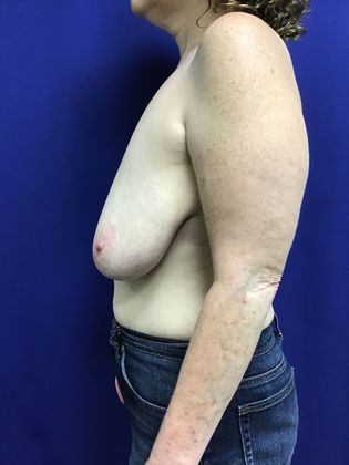 Breast Reduction: Case 28 (23323) - Before