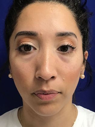 Injectables Minimally-Invasive / Fillers: Case 20 (30157) - Before