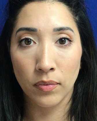 Injectables Minimally-Invasive / Fillers: Case 20 (30157) - After