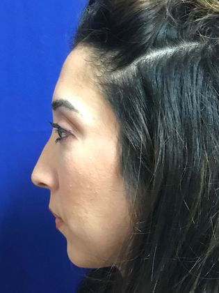 Injectables Minimally-Invasive / Fillers: Case 20 (30157) - After