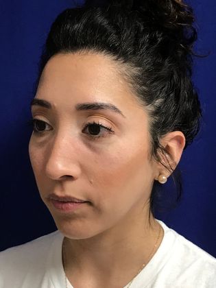 Injectables Minimally-Invasive / Fillers: Case 20 (30157) - Before