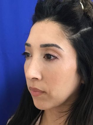 Injectables Minimally-Invasive / Fillers: Case 20 (30157) - After