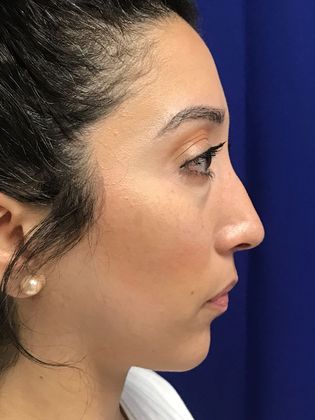 Injectables Minimally-Invasive / Fillers: Case 20 (30157) - Before