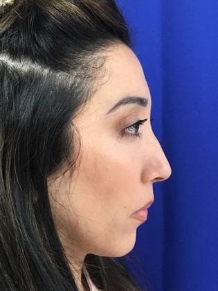 Injectables Minimally-Invasive / Fillers: Case 20 (30157) - After