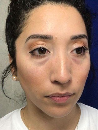 Injectables Minimally-Invasive / Fillers: Case 20 (30157) - Before