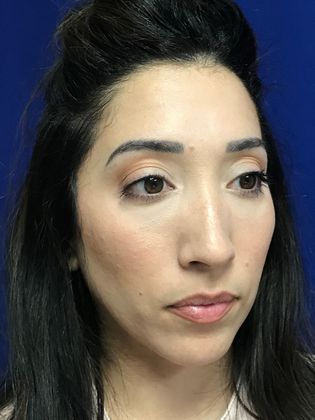 Injectables Minimally-Invasive / Fillers: Case 20 (30157) - After