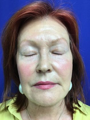 Facial Eyelid Surgery / Blepharoplasty: Case 11 (11387) - Before