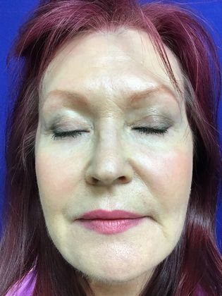 Facial Eyelid Surgery / Blepharoplasty: Case 11 (11387) - After