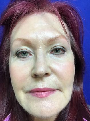 Facial Eyelid Surgery / Blepharoplasty Case 11 (11387) - After