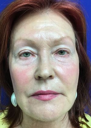 Facial Eyelid Surgery / Blepharoplasty Case 11 (11387) - Before