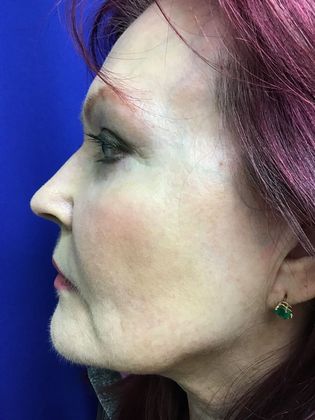 Facial Eyelid Surgery / Blepharoplasty: Case 11 (11387) - After