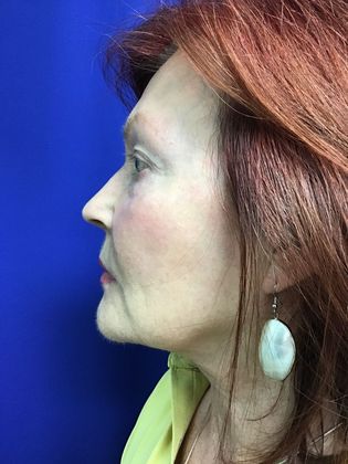 Facial Eyelid Surgery / Blepharoplasty: Case 11 (11387) - Before