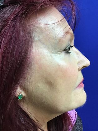 Facial Eyelid Surgery / Blepharoplasty: Case 11 (11387) - After