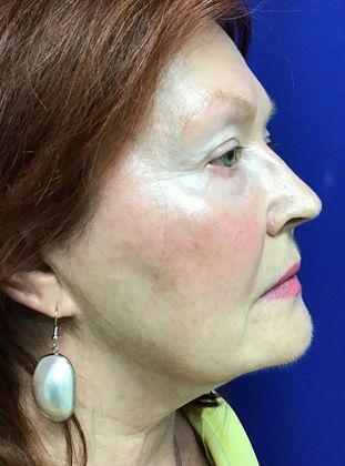 Facial Eyelid Surgery / Blepharoplasty: Case 11 (11387) - Before