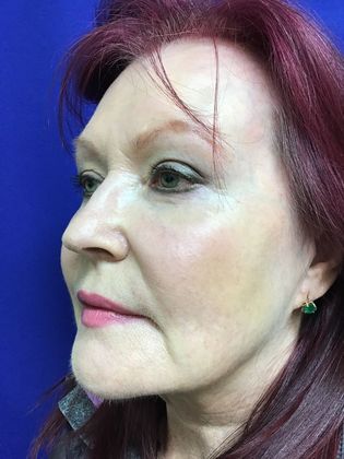 Facial Eyelid Surgery / Blepharoplasty: Case 11 (11387) - After