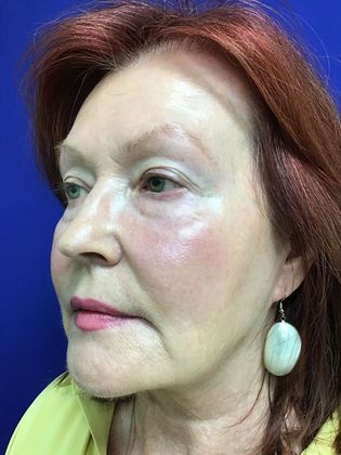 Facial Eyelid Surgery / Blepharoplasty: Case 11 (11387) - Before