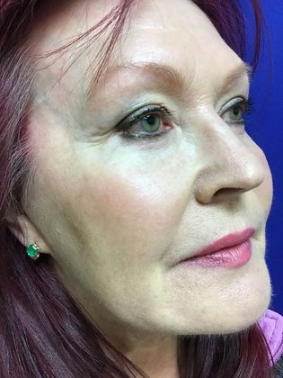 Facial Eyelid Surgery / Blepharoplasty: Case 11 (11387) - After