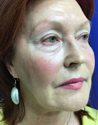 Facial Eyelid Surgery / Blepharoplasty: Case 11 (11387) - Before