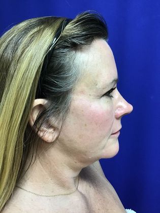Facial Facelift / Necklift: Case 22 (22789) - After