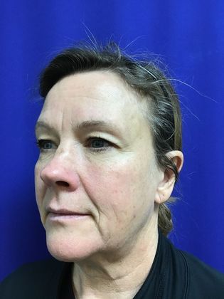Facial Facelift / Necklift: Case 22 (22789) - Before