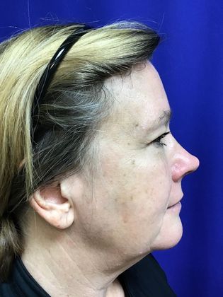 Facial Facelift / Necklift: Case 22 (22789) - Before