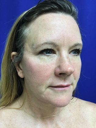 Facial Facelift / Necklift Case 22 (22789) - After