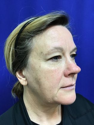 Facial Facelift / Necklift Case 22 (22789) - Before