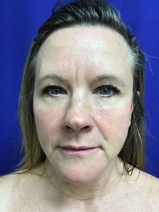 Facial Facelift / Necklift: Case 22 (22789) - Before
