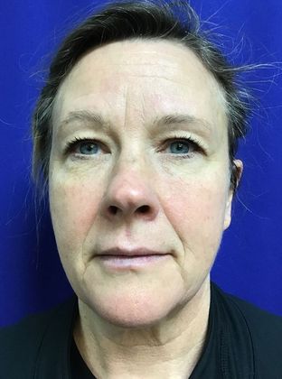 Facial Facelift / Necklift: Case 22 (22789) - Before