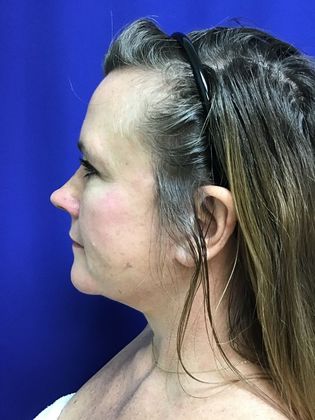 Facial Facelift / Necklift: Case 22 (22789) - After