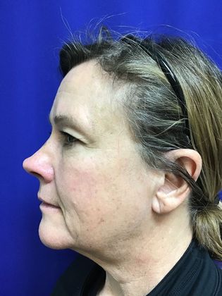 Facial Facelift / Necklift: Case 22 (22789) - Before