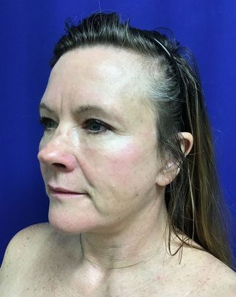 Facial Facelift / Necklift: Case 22 (22789) - After