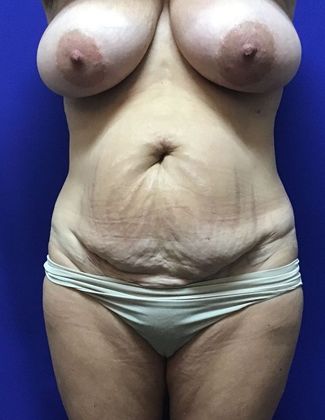 Body Mommy Make-Over: Case 9 (22789) - Before