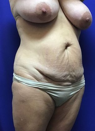 Body Mommy Make-Over: Case 9 (22789) - Before