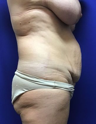 Body Mommy Make-Over: Case 9 (22789) - Before