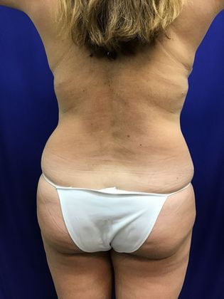 Body Mommy Make-Over: Case 9 (22789) - After