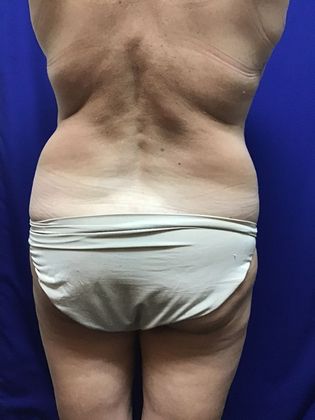 Body Mommy Make-Over: Case 9 (22789) - Before