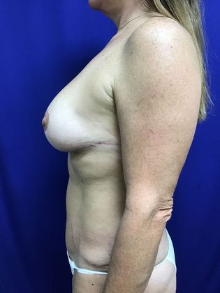 Body Mommy Make-Over: Case 9 (22789) - After